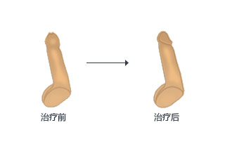 美式無(wú)痛無(wú)痕包皮整形術(shù)